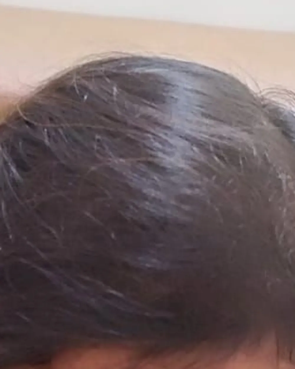 Patient A, front of the scalp and parting at a later visit, after a plan prescribed by the doctor. Face not shown.
