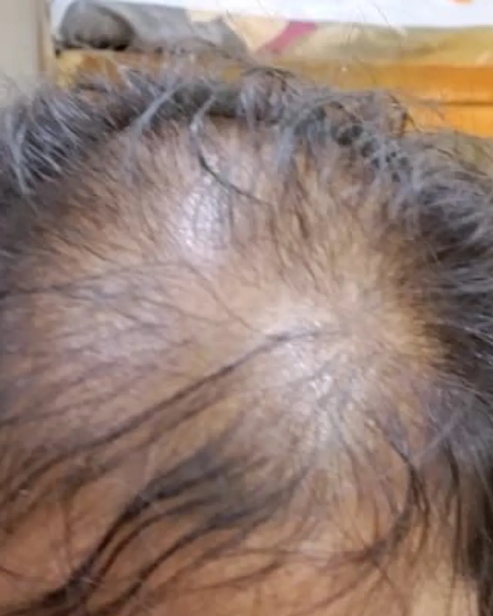 Patient A, front of the scalp and parting before starting a plan. Face not shown.