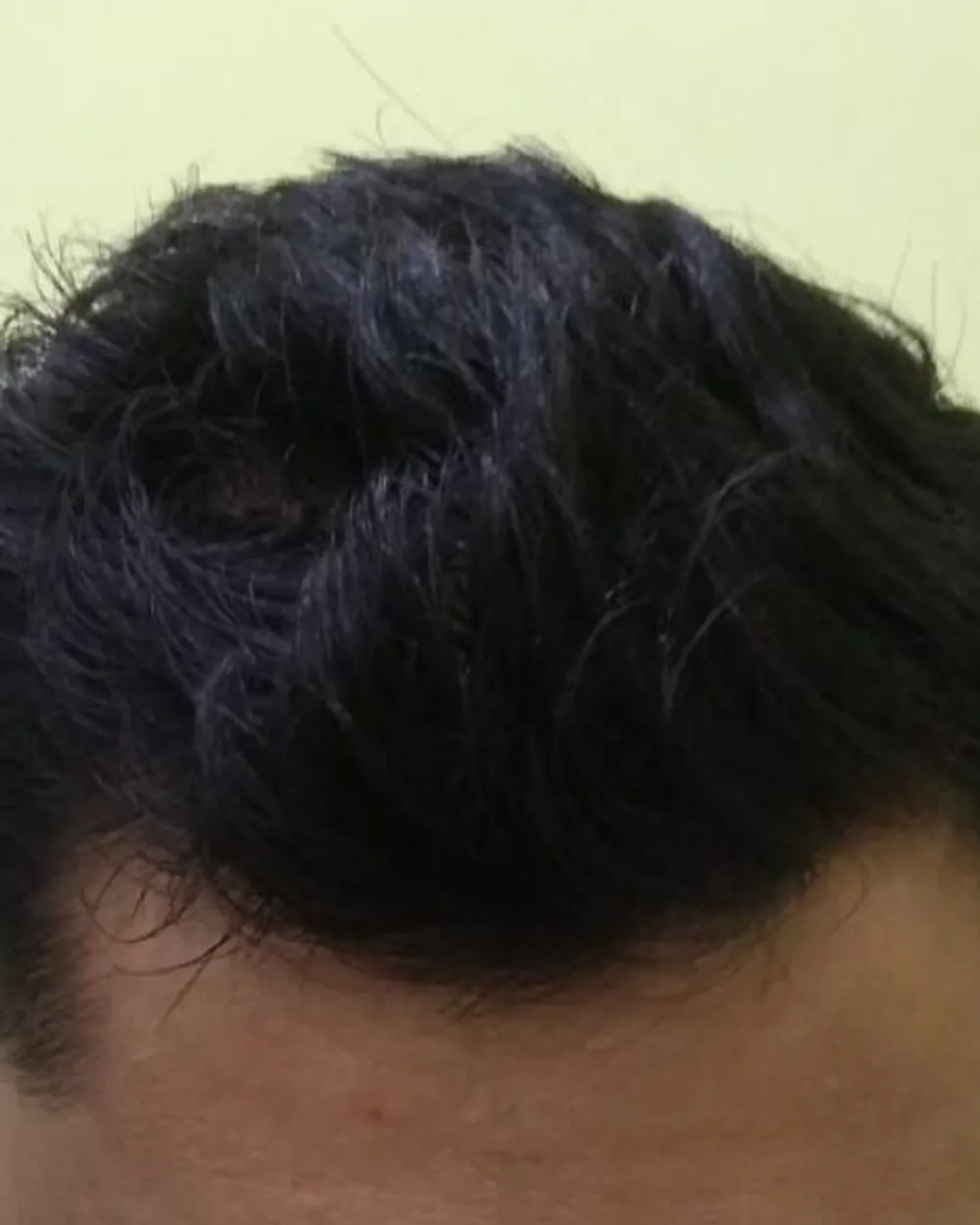 Patient B, front and top of the scalp at a later visit, after a plan prescribed by the doctor. Face not shown.