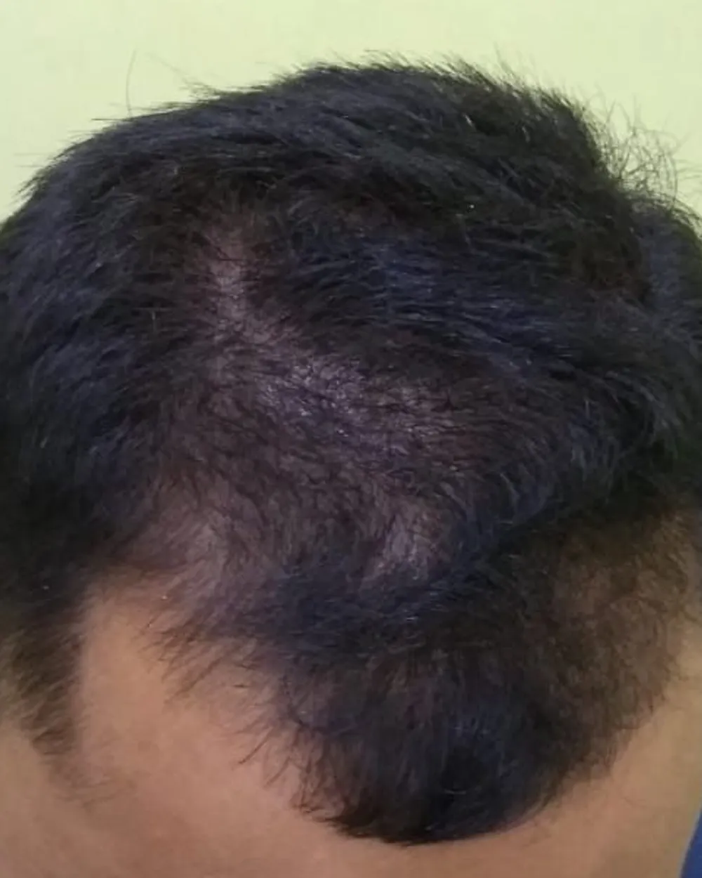 Patient B, front and top of the scalp before starting a plan: thinning behind the hairline. Face not shown.