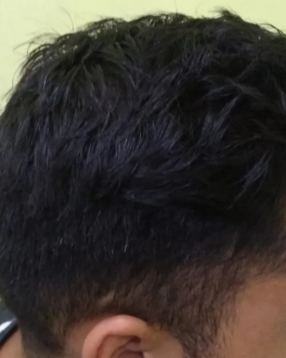 Patient B, side of the head at a later visit, after a plan prescribed by the doctor. Face not shown.