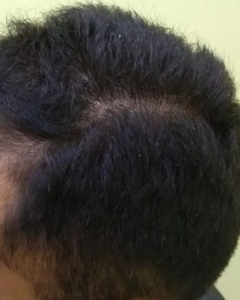 Patient B, side of the head and temple before starting a plan. Face not shown.