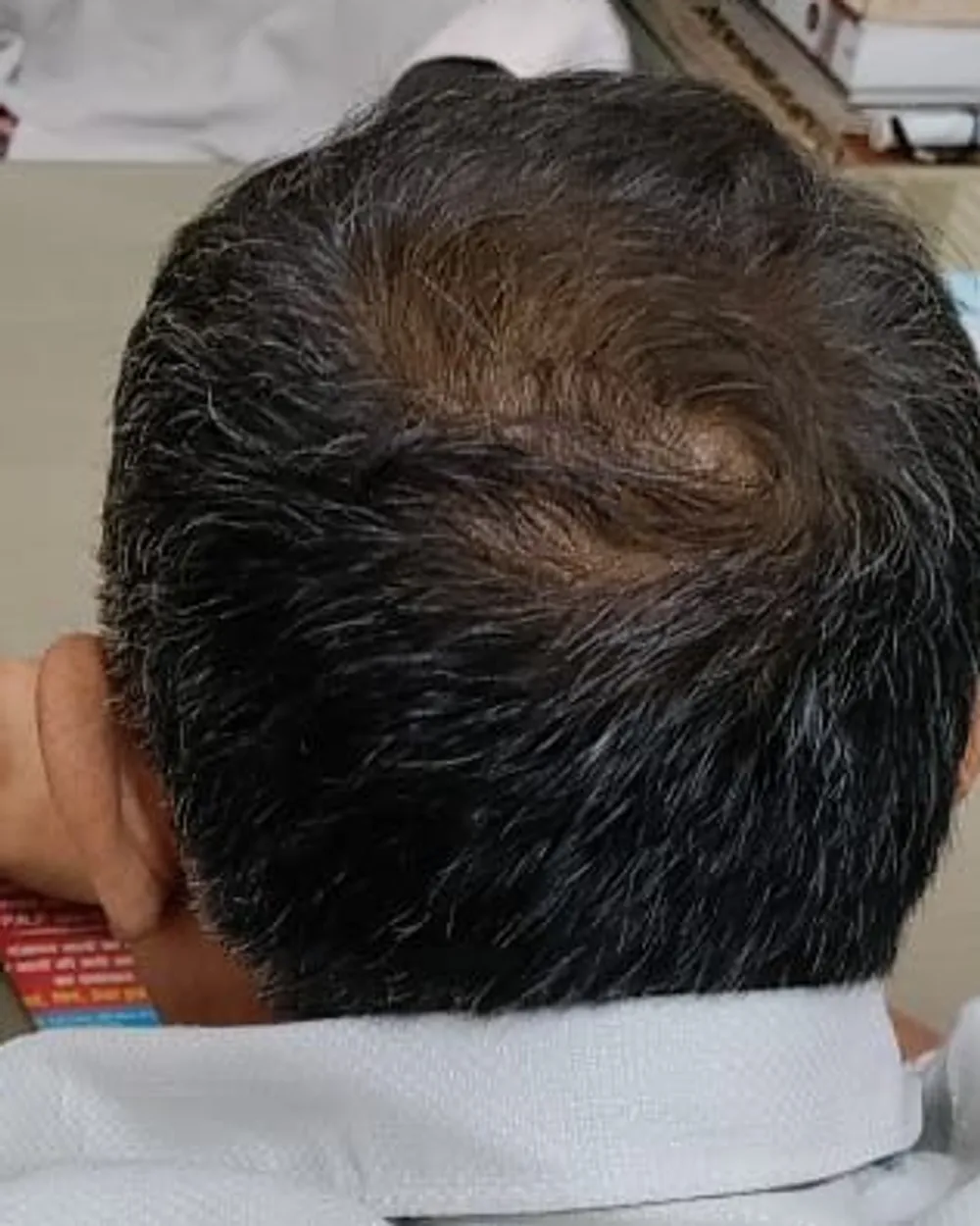Patient C, crown seen from behind at a later visit, after a plan prescribed by the doctor. Face not shown.