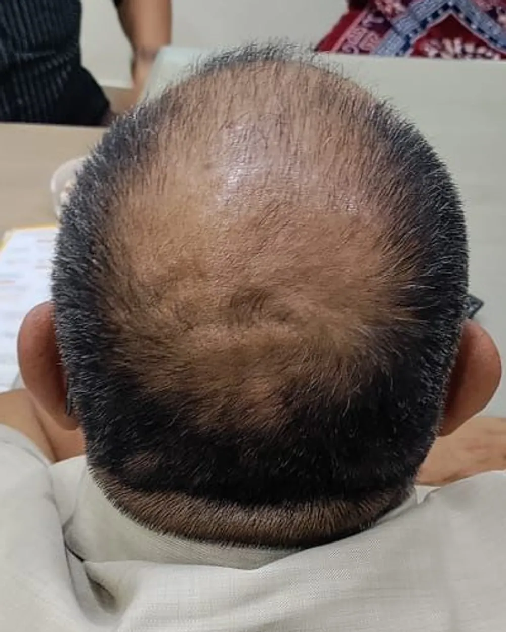 Patient C, crown seen from behind before starting a plan: the scalp is visible through thin hair. Face not shown.