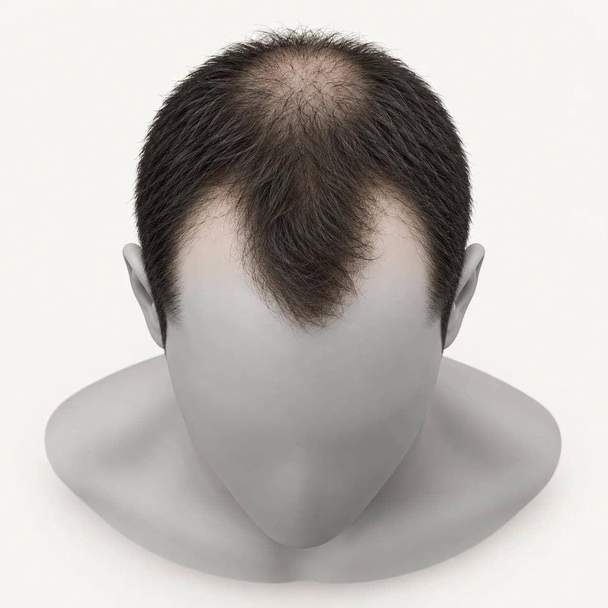 Illustration: male pattern hair loss at the temples and crown