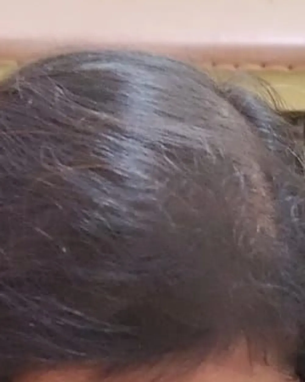 Patient A, top of the scalp at a later visit, after a plan prescribed by the doctor. Face not shown.