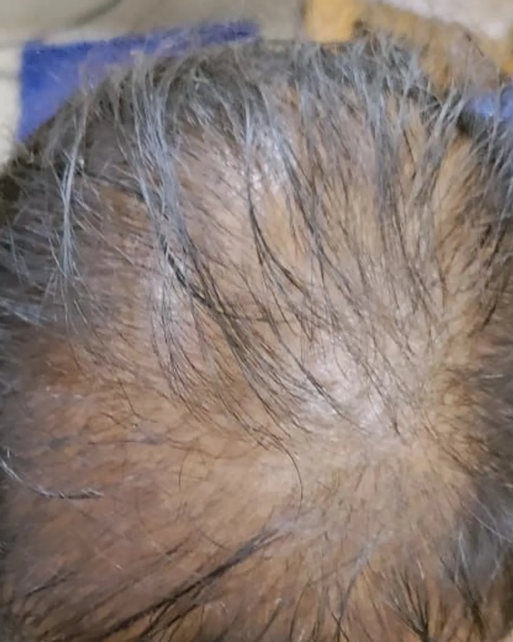 Patient A, top of the scalp before starting a plan: the scalp shows through thin hair along the parting. Face not shown.